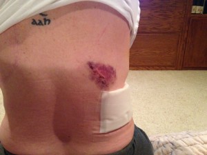 One of the 4 incisions. Chest tube incision is covered by the bandage. 